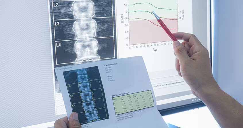 Opinia Pani Bożeny – Pacjentki z Osteoporozą