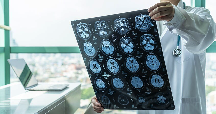Choroba Alzheimera – objawy, leczenie, przyczyny