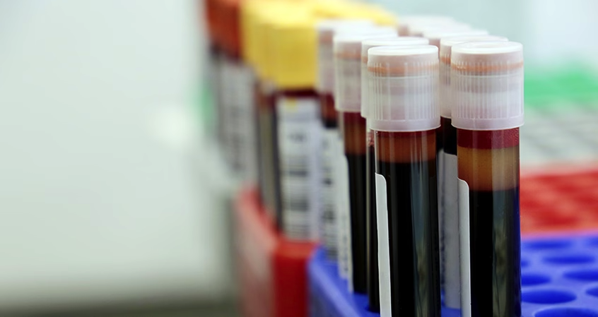 Co to jest hipertriglicerydemia?
